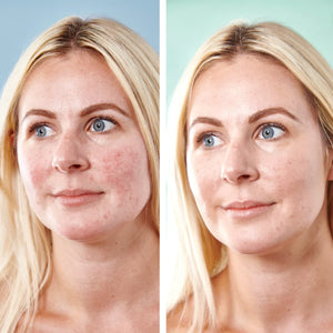 Sorted Skin - 5 in 1 Anti-Redness Day Cream SPF50 | 30 ml